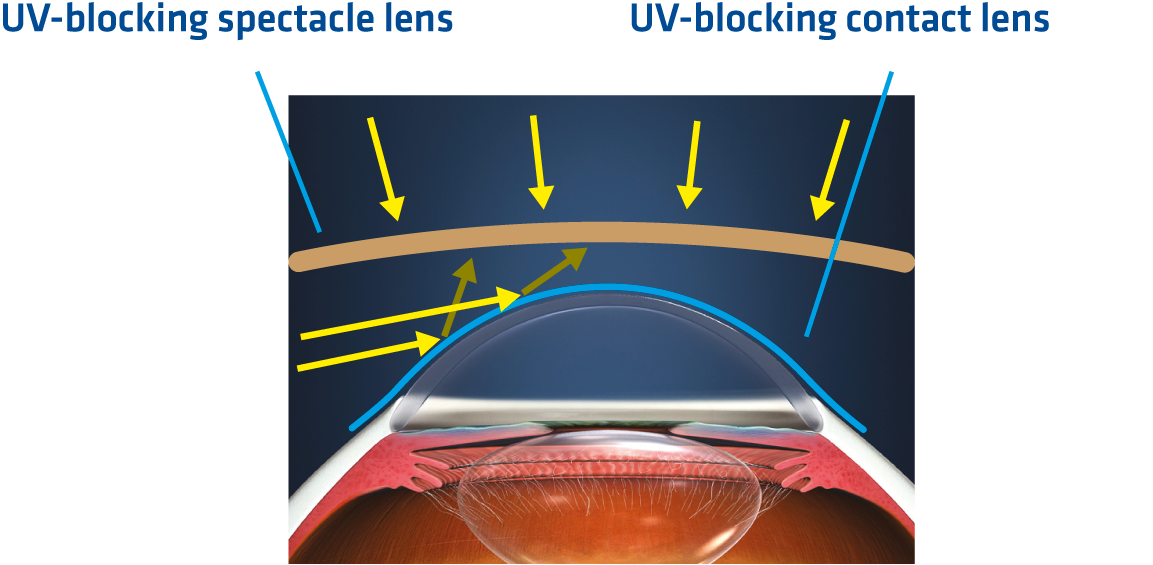 UV-blocking – spectacle and contact lens